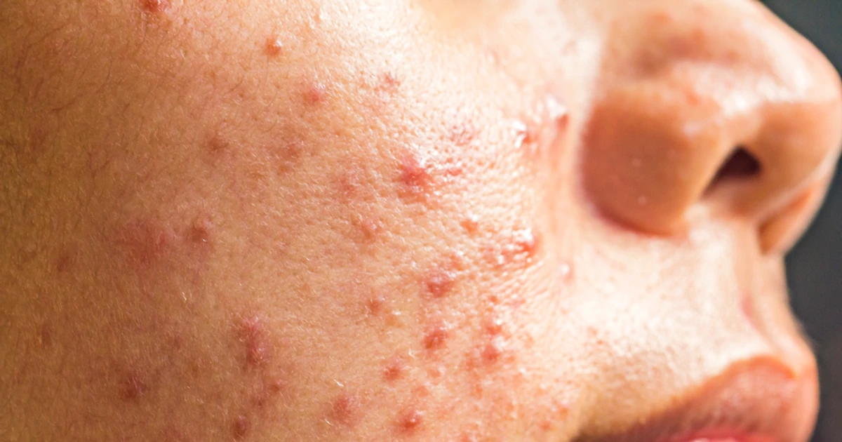 Acne Spiritual Meanings And Interpretations